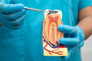 tooth with a cavity - Bruno Integrative Dentistry Gloved hands hold a dental anatomy model while a dental explorer points at a tooth cross-section for teaching purposes.